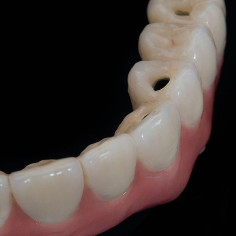 implantes asdent