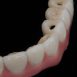 implantes asdent